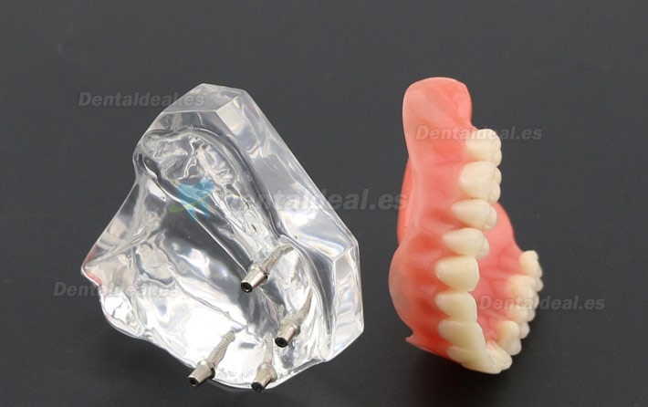 Dental Study Teeth Model Overdenture Superior With 4 Implants Demo Model 6001